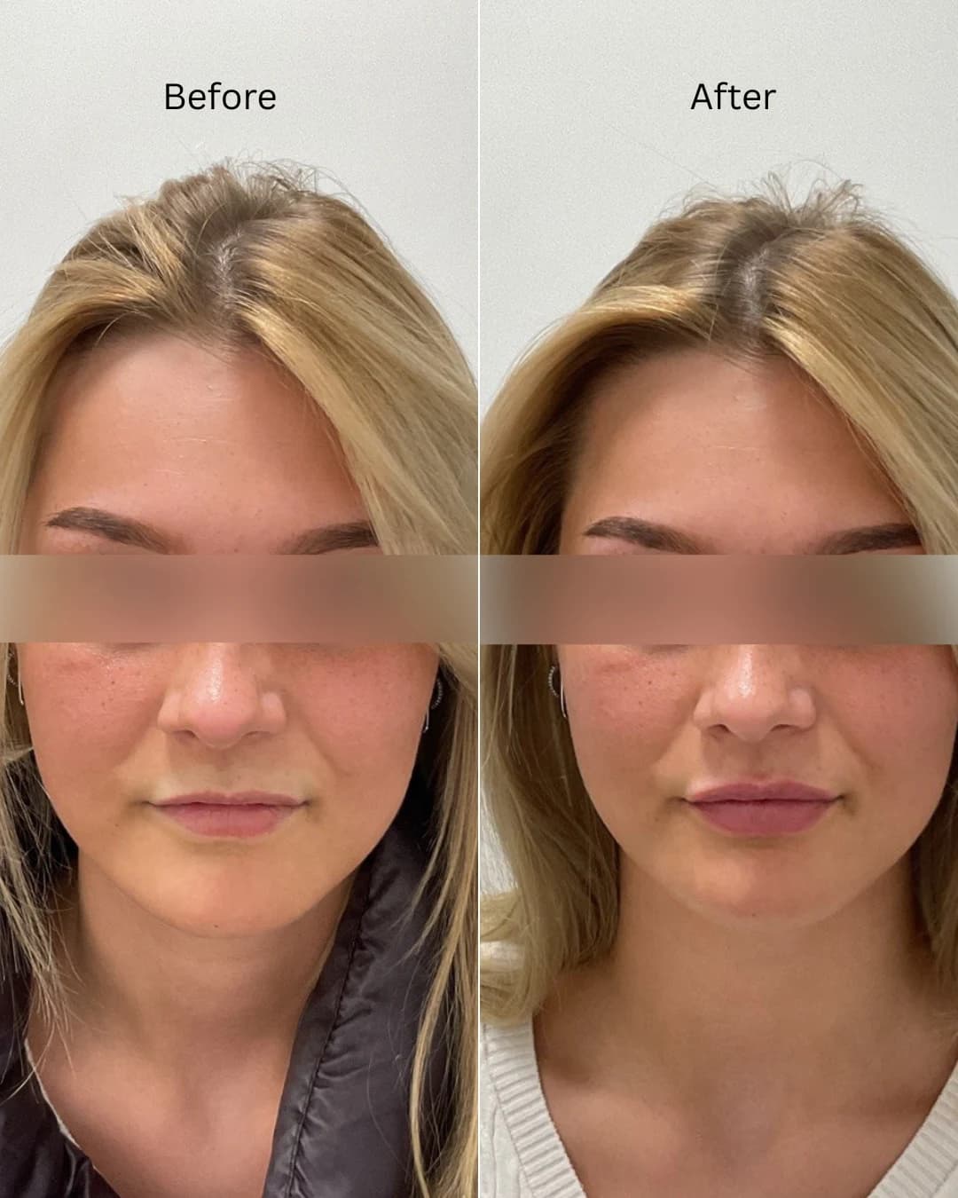 Before and after treatment result