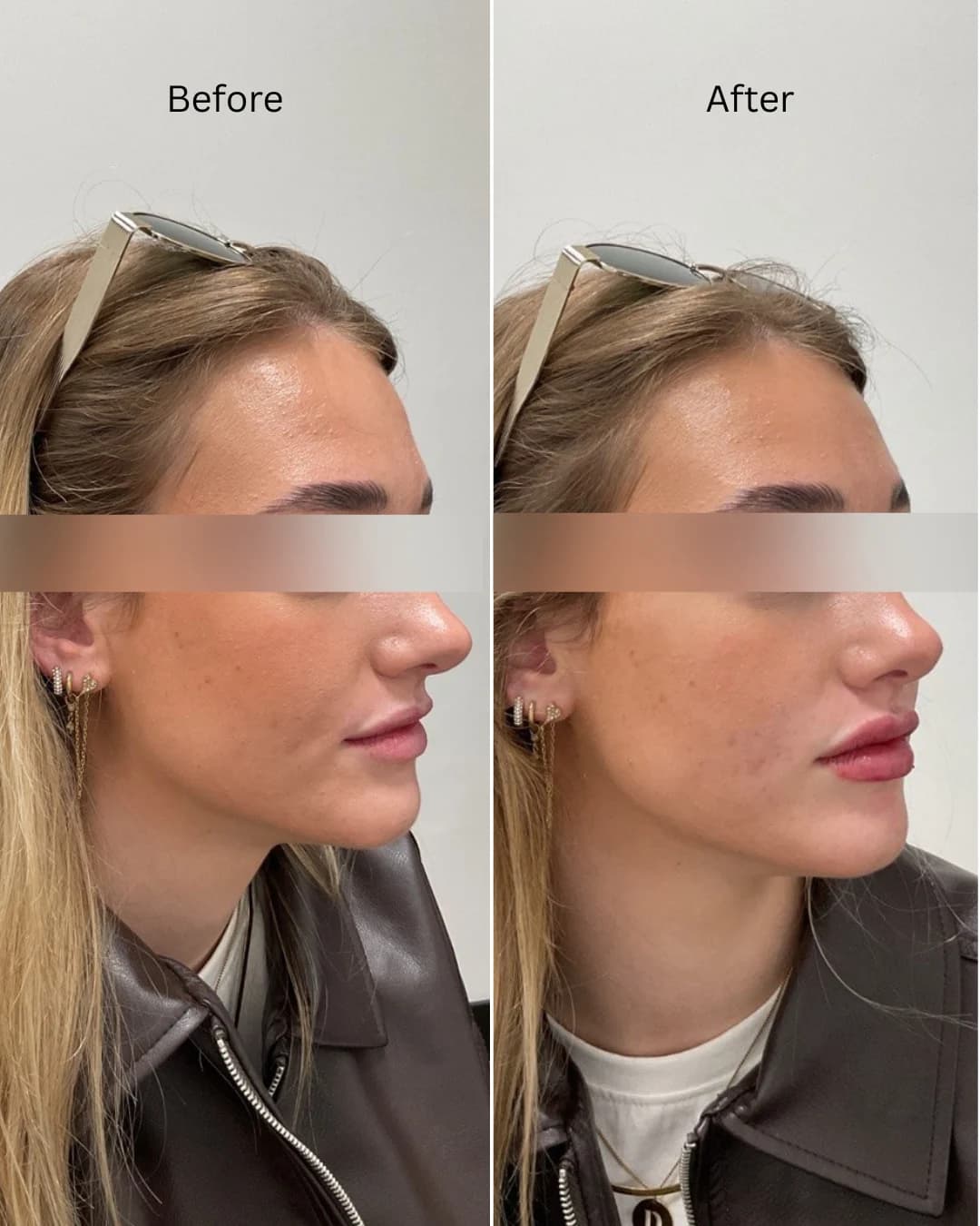 Before and after treatment result