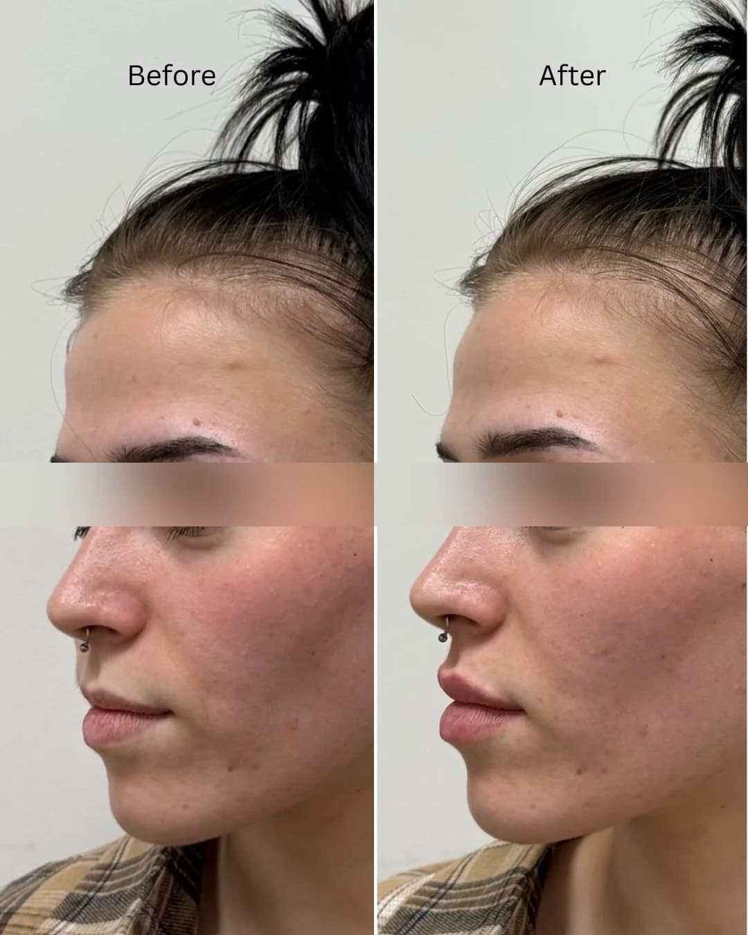 Before and after treatment result